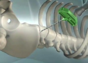 Stem-Cell-therapy-extracting-bone-marrow-300x216