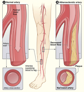 Stem Cells Peripheral Arterial Disease