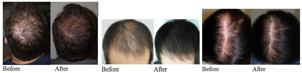 Stem Cells for hair loss