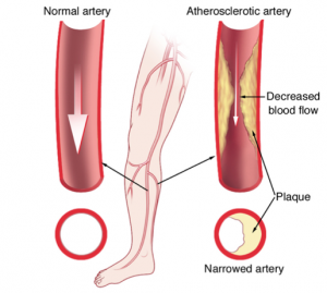 Stem Cell Therapy for Peripheral Arterial Disease