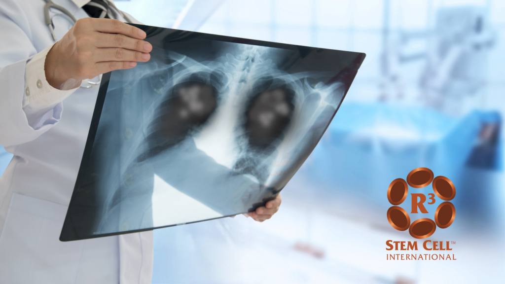 stem cell treatment emphysema stem cell treatment emphysema
