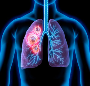 stem cell lung disease Pakistan