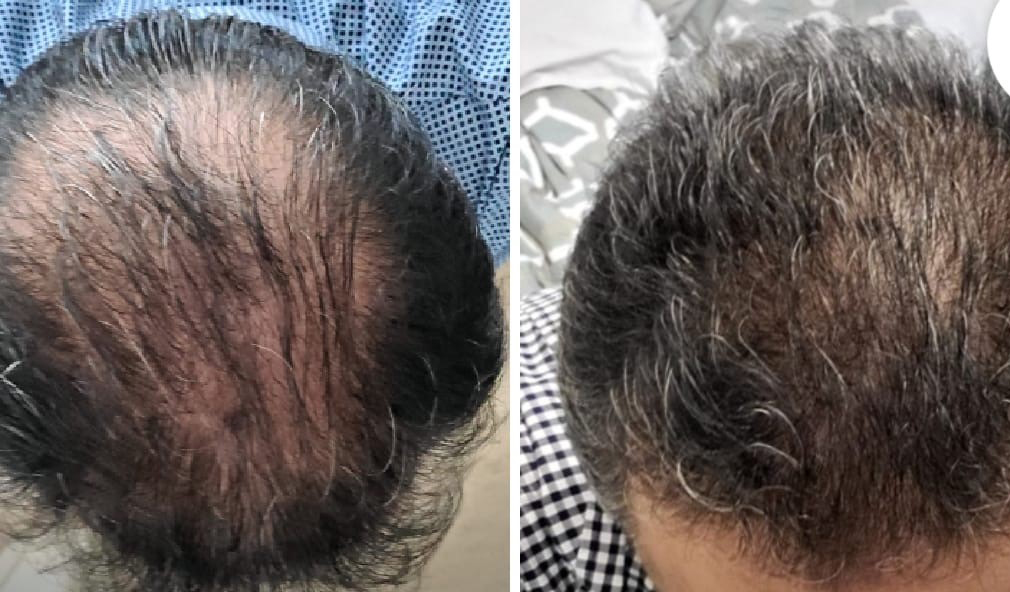 Hair Fall Karachi Stem Cell Treatment in Pakistan