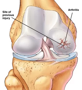 Knee Regeneration Treatment