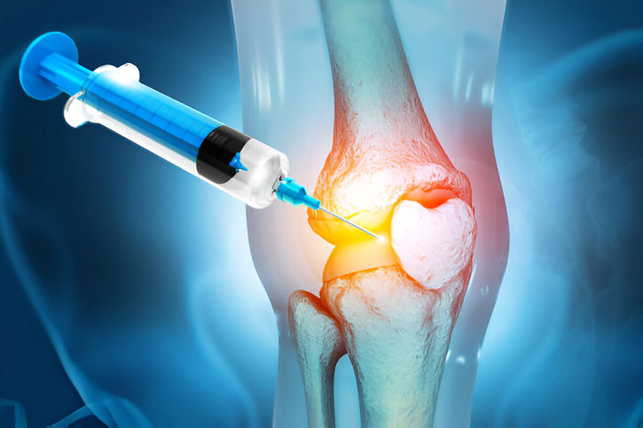 A detailed 3D medical illustration of the human knee joint anatomy, showing the femur, tibia, and patella, used to explain regenerative medicine and joint pain therapy.