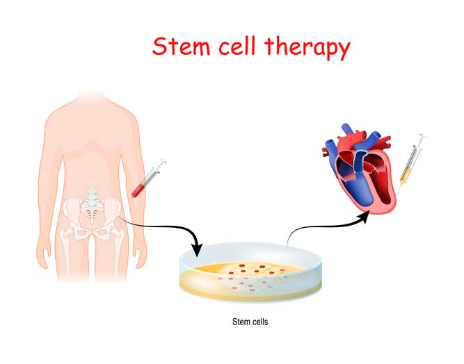 Exosome therapy in Phoenix Arizona