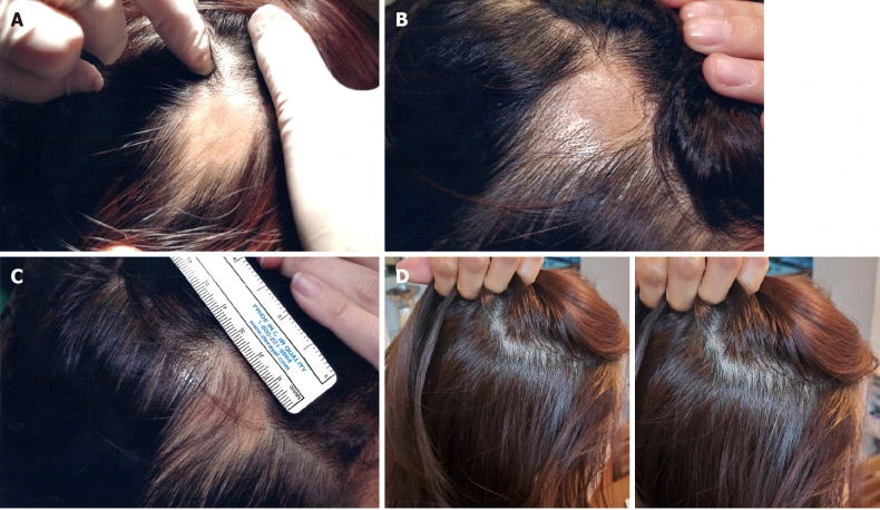 Four panels showcasing the progression of hair density improvement through stem cell therapy for androgenetic alopecia, measured and compared over different stages.