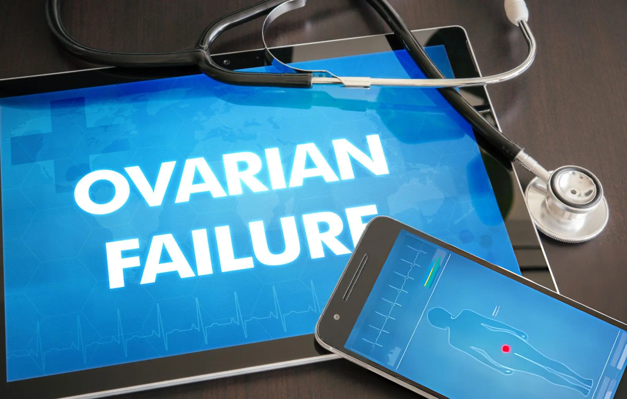 Tablet with the text "OVARIAN FAILURE" in bold letters, accompanied by a stethoscope and a smartphone showing a medical diagram, symbolizing the precision and care in protocols for treating POF with stem cell and exosome therapies.