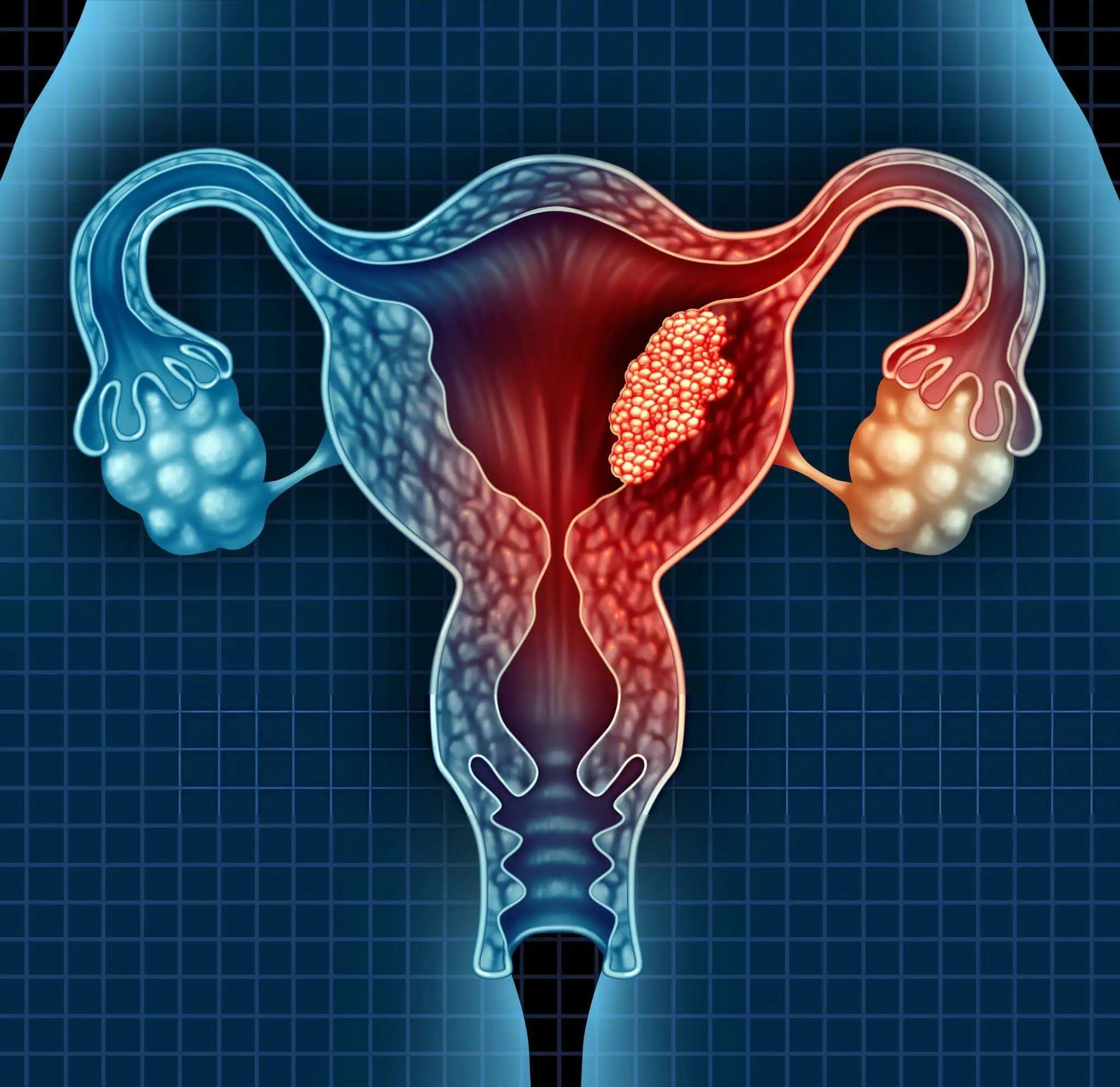 A medical illustration showing the female reproductive system, with ovaries highlighted in blue and red to depict functional abnormalities related to Premature Ovarian Failure (POF), and a grid pattern in the background for a clinical representation.
