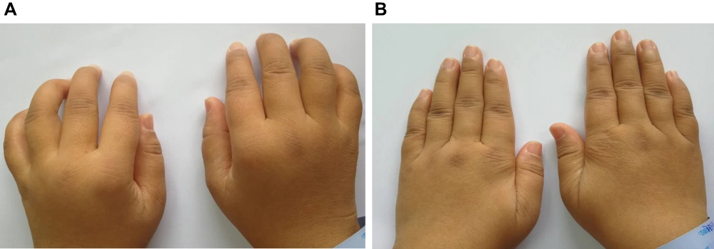 Clinical illustration showcasing patient improvements after umbilical cord stem cell therapy for rheumatoid arthritis.