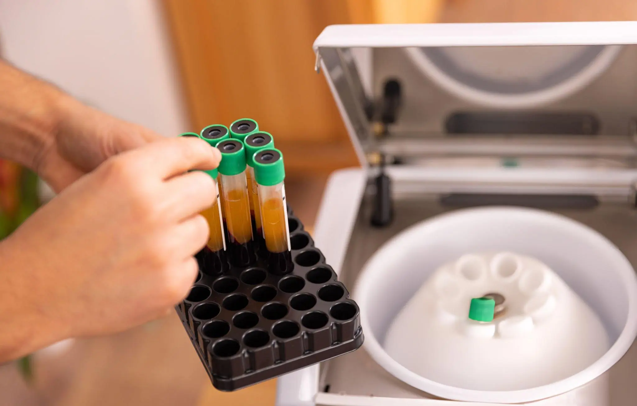 A laboratory technician holding a tray with test tubes of separated blood plasma, with a centrifuge in the background, symbolizing the process of preparing biologics for stem cell and exosome therapies.