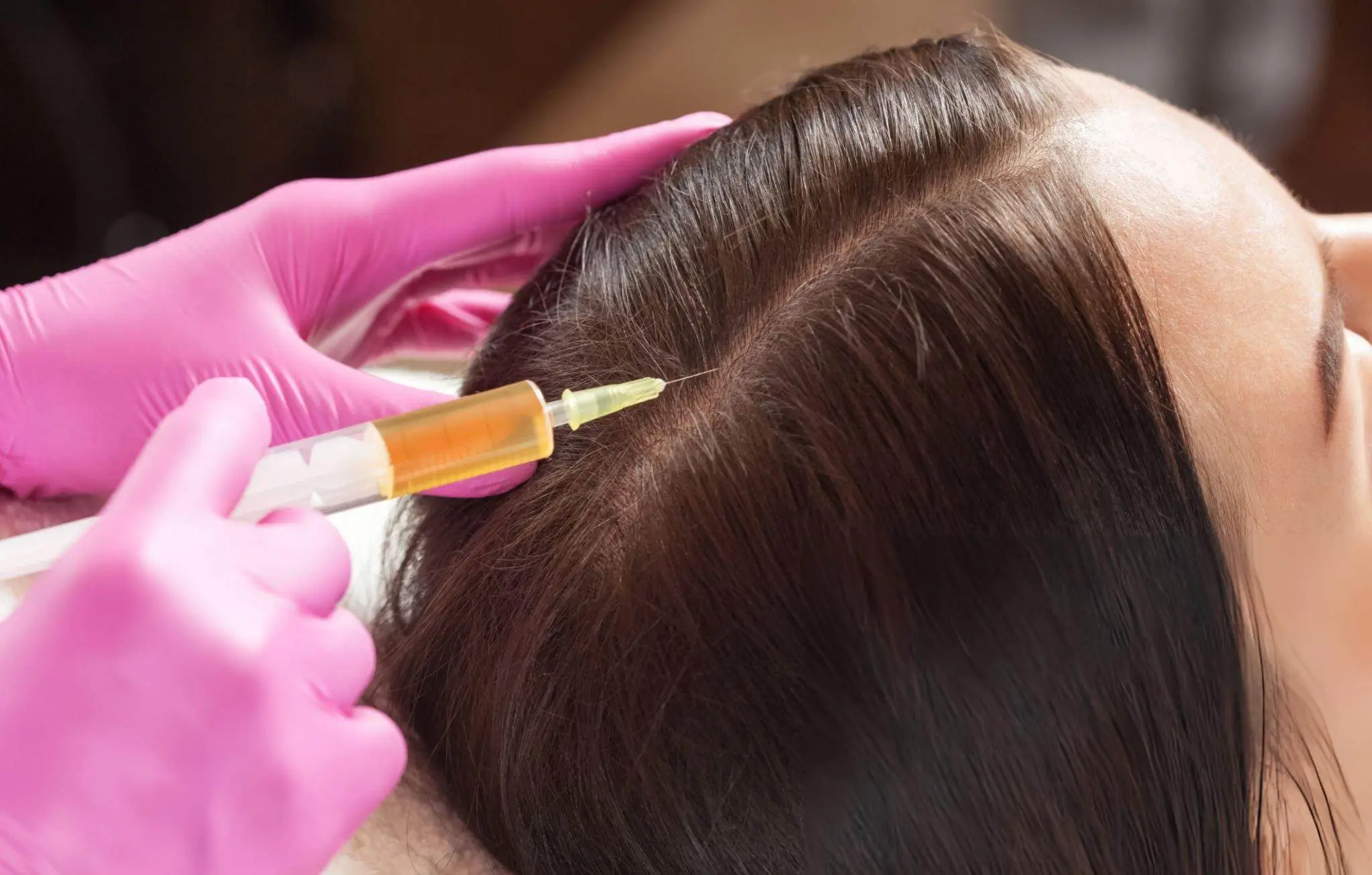 Close-up of a scalp injection procedure being conducted by a professional wearing pink gloves, showcasing the administration of PRP, stem cells, and exosomes for hair regeneration.