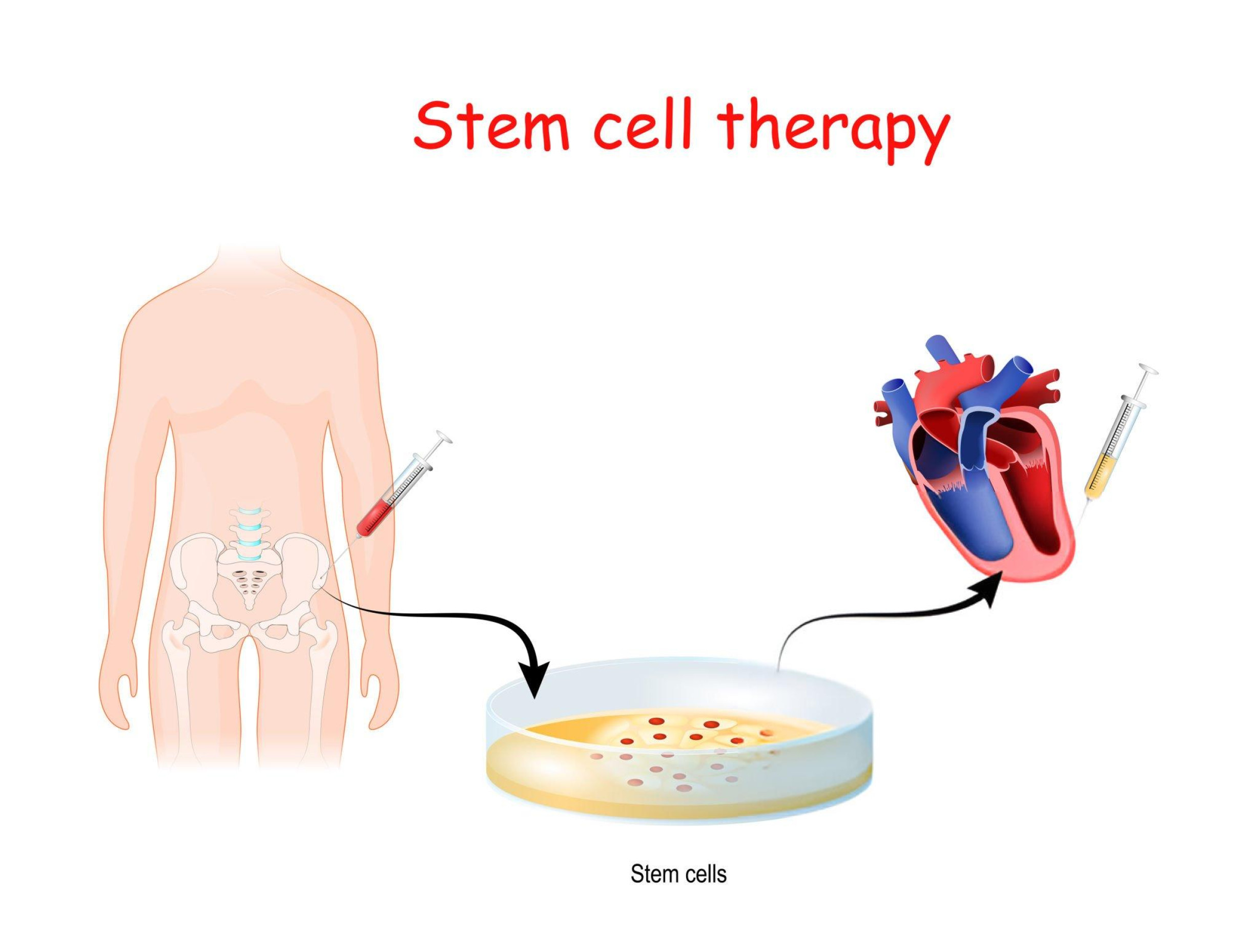 A diagram illustrating the process for stem cell therapy, where a patient's own cells are harvested and used in non-surgical treatments available in Westwood, MA.