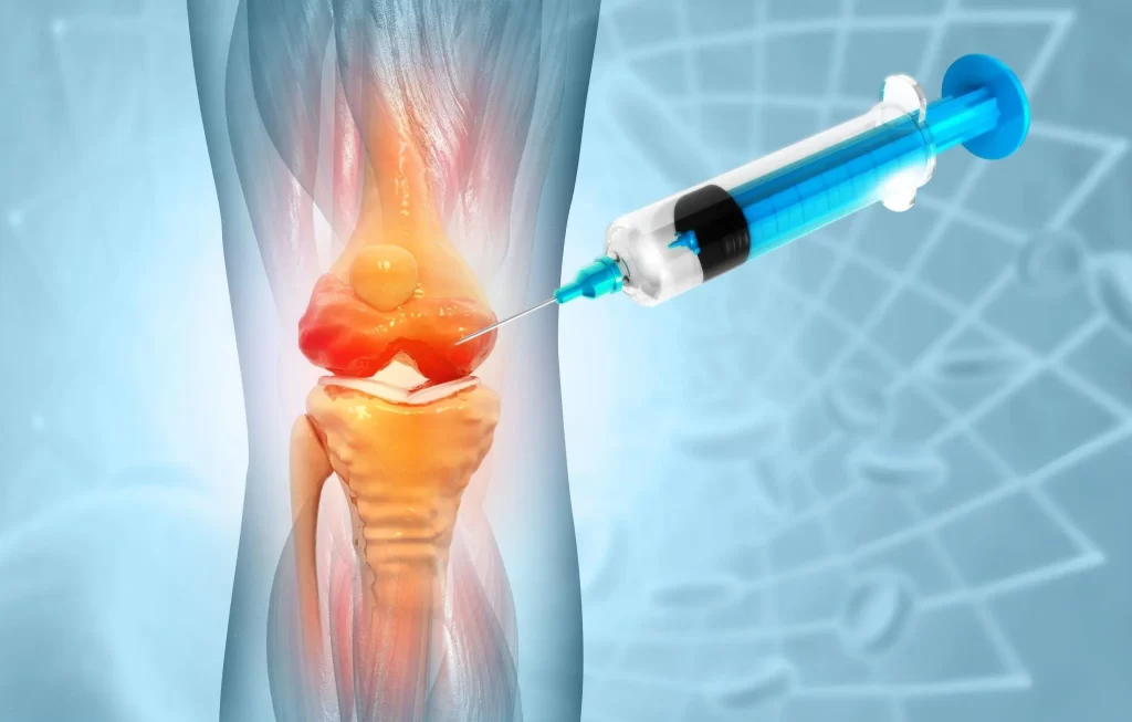 Medical illustration of syringe injecting into inflamed knee, representing how stem cell therapy is administered to promote cartilage repair