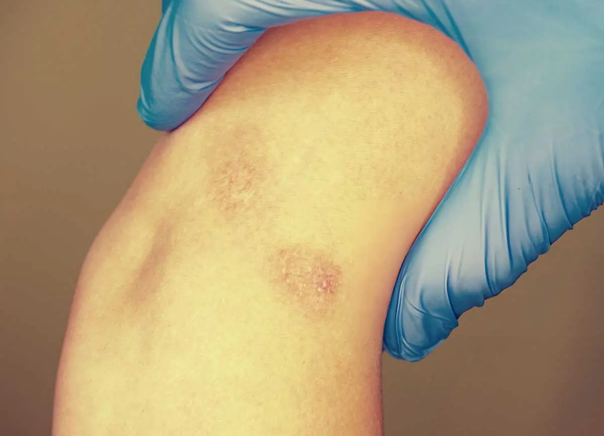 A medical professional in blue gloves examining a patch of thin, discolored skin on a patient to provide a clinical diagnosis of Lichen Sclerosus.