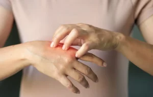 Close-up of a patient scratching a red, inflamed atopic dermatitis eczema rash on the hand, highlighting the need for regenerative treatments like stem cell therapy.