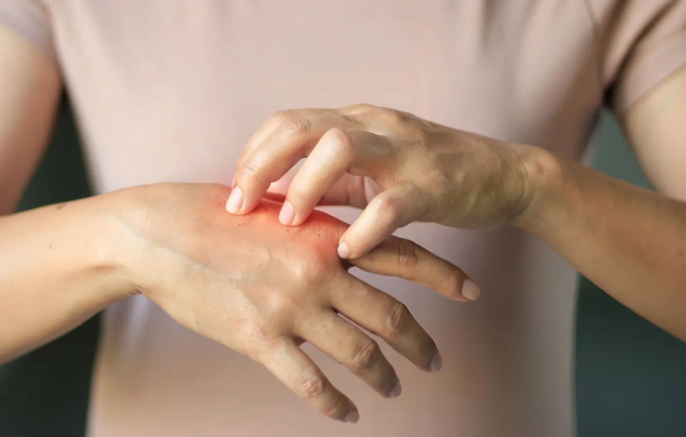 Close-up of a patient scratching a red, inflamed atopic dermatitis eczema rash on the hand, highlighting the need for regenerative treatments like stem cell therapy.