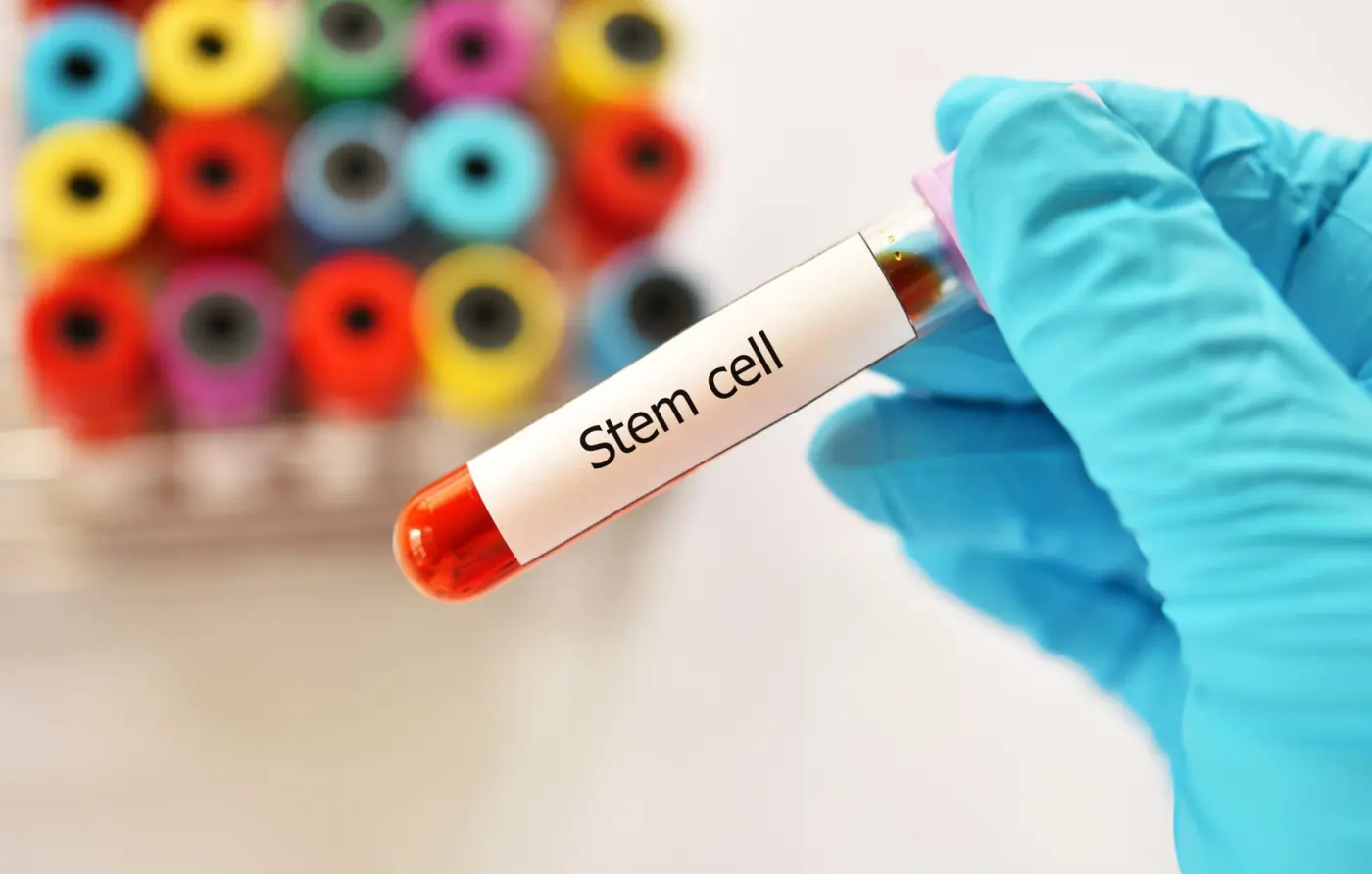 A close-up of a stem cell therapy preparation tube held by a medical researcher in a laboratory.
