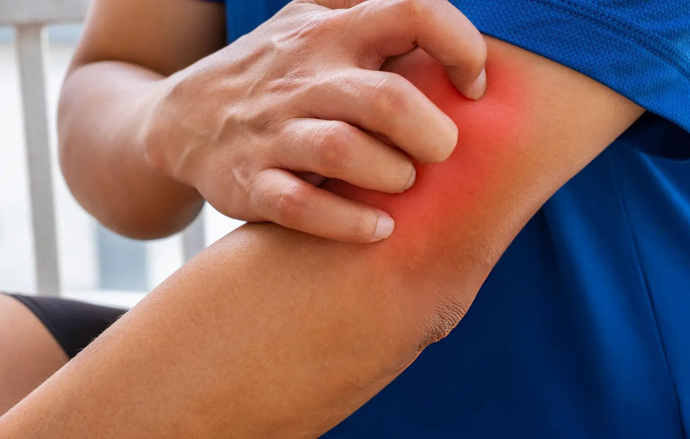 A close-up of a person scratching a red, inflamed rash on their upper arm near the elbow, illustrating an early skin reaction or erythema migrans rash associated with Lyme disease.