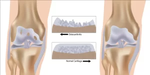 Medical illustration comparing an osteoarthritic knee joint with degraded cartilage to a healthy knee joint with normal smooth cartilage thickness.