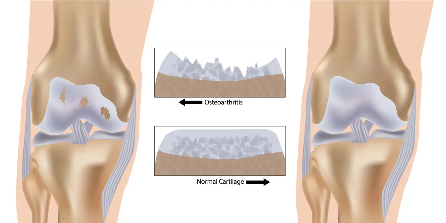 Medical illustration comparing an osteoarthritic knee joint with degraded cartilage to a healthy knee joint with normal smooth cartilage thickness.