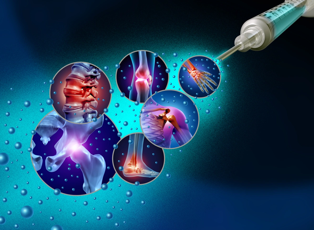 Medical graphic showing syringe injecting stem cells into joint conditions