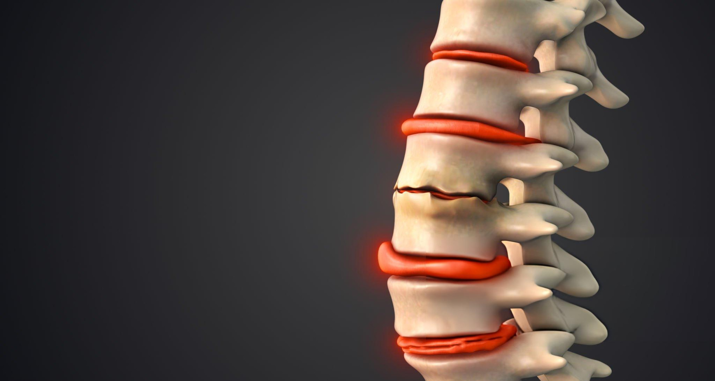 A 3D medical illustration of a human lumbar spine showing a ruptured intervertebral disc with localized red inflammation highlighting the area of spinal degeneration.