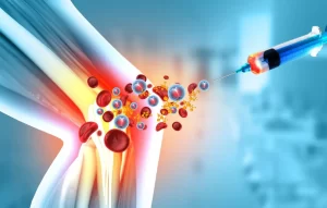 3D medical illustration showing a stem cell injection into a knee joint affected by arthritis to stimulate cartilage repair and reduce inflammation.