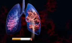 Mesenchymal stem cell therapy for cigarette smoke lung damage