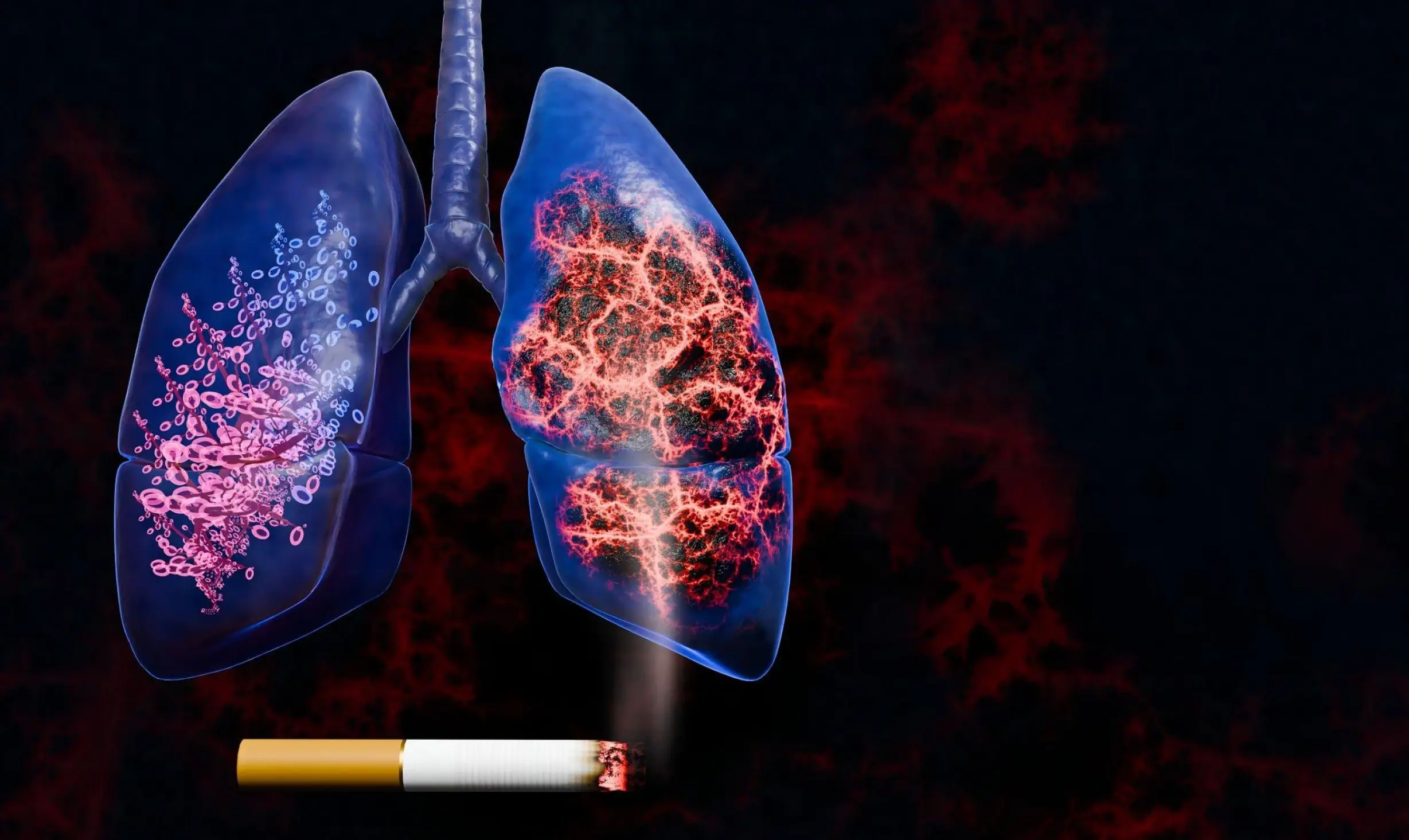 Mesenchymal stem cell therapy for cigarette smoke lung damage