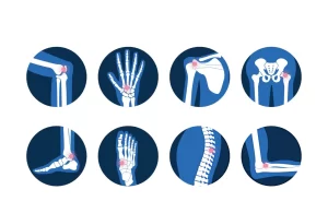 Diagram showing joint pain sites suitable for stem cell injections