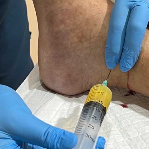 Neuropathy-Injection6-qlpvwwxbw4h79xngg1f27wgwe32tf24b8du3tsn8jg